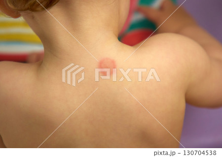 View of a child shoulder displaying a mosquito bite that has caused noticeable redness and irritation View of a child shoulder displaying a mosquito bite that has caused noticeable redness and irritation 130704538