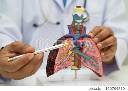Pneumonia, lung cancer, Asian doctor holding human anatomy model for study diagnosis and treatment in hospital. Pneumonia, lung cancer, Asian doctor holding human anatomy model for study diagnosis and treatment in hospital. 130704810
