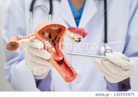 Uterus, doctor holding human anatomy model for study diagnosis and treatment in hospital. Uterus, doctor holding human anatomy model for study diagnosis and treatment in hospital. 130705975
