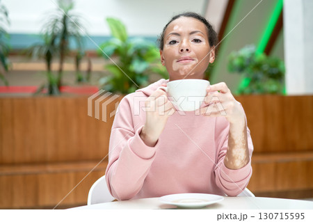 Black african american woman with vitiligo 130715595