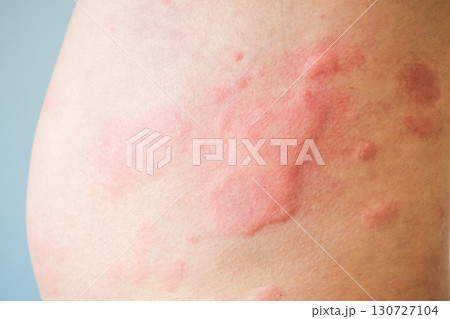 Skin allergy rash dermatitis texture close up background 130727104