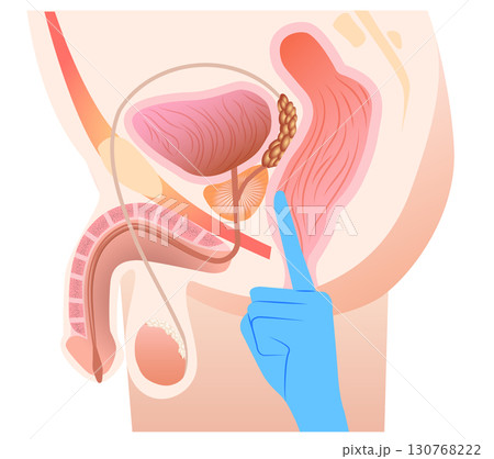 前立腺マッサージ位置 前立腺マッサージ位置 130768222