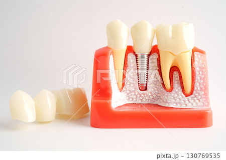 Dental implant, artificial tooth roots into jaw. 130769535