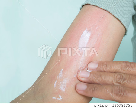 Hand with Urticaria Allergy Itchy Rash Eczema Itch Woman from Food,Air Poisoning,Cosmetic,Health,Body Care Disease Lilness Air,Dissease Medicine Calamine Lotion Treatment ,Infection Pain Sick Scratch. 130786756
