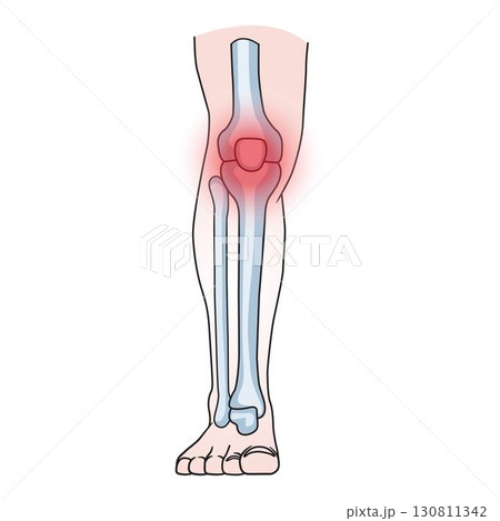 human knee joint with highlighted pain area, concept for arthritis, injury, and anatomy study. 130811342