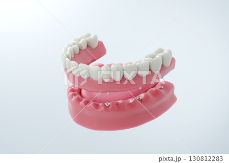 インプラントブリッジによる下顎の治療 多数歯欠損を補う最新技術 インプラントブリッジによる下顎の治療 多数歯欠損を補う最新技術 130812283