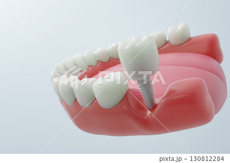 ジルコニアクラウンの装着 3Dで見るインプラント治療の最終工程 130812284
