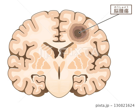 脳腫瘍のイラスト Brain tumor illustration 130821624