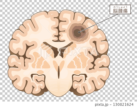 脳腫瘍のイラスト Brain tumor illustration 130821624