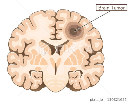 脳腫瘍のイラスト Brain tumor illustration 脳腫瘍のイラスト Brain tumor illustration 130821625