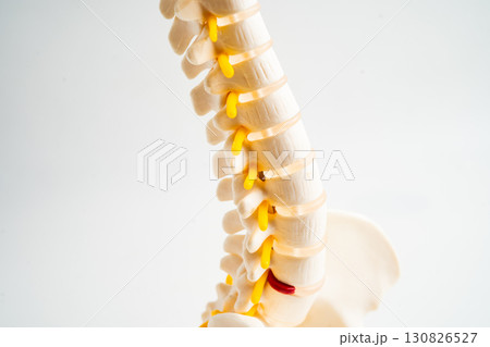 Lumbar spine displaced herniated disc fragment, spinal nerve and bone. Model for treatment medical in the orthopedic department. 130826527