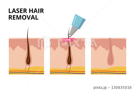 Laser hair removal treatment destroying hair follicle under skin Laser hair removal treatment destroying hair follicle under skin 130835816