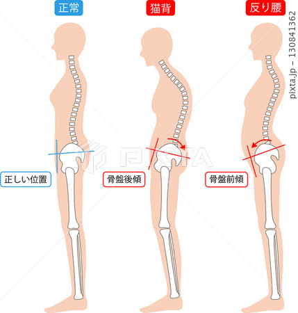 正しい姿勢と猫背と反り腰の女性 背骨と骨盤 正しい姿勢と猫背と反り腰の女性 背骨と骨盤 130841362