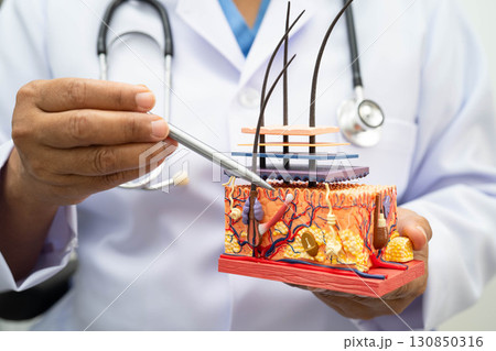 Hair transplant, Asian dermatologist doctor holding skin structure anatomy model for treatment in hospital. 130850316