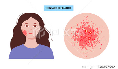Contact dermatitis poster 130857592