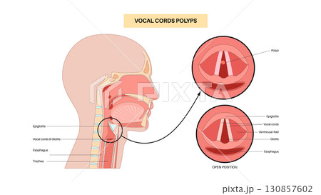 Vocal cord polyps 130857602