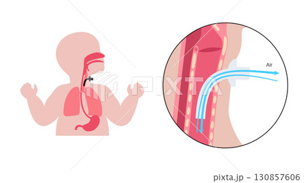 Tracheostomy medical poster 130857606