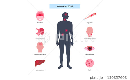 Mononucleosis symptoms poster 130857608