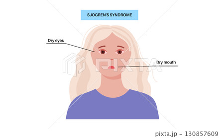 Sjogrens syndrome disease 130857609
