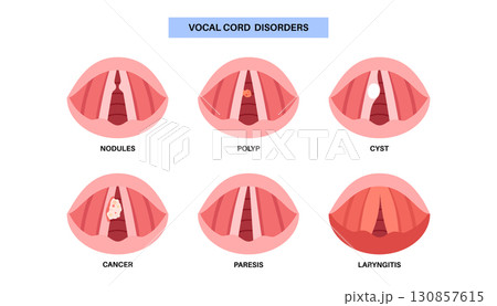 Vocal cord lesions 130857615