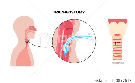 Tracheostomy medical poster Tracheostomy medical poster 130857617