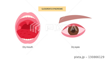 Sjogrens syndrome disease 130866129