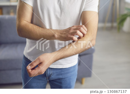Man scratches his hand due to allergic reaction, trying to relieve itching sensation. Man scratches his hand due to allergic reaction, trying to relieve itching sensation. 130867137