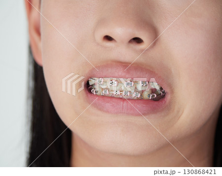 子供が楽しく歯の矯正の口の様子を見せます 130868421