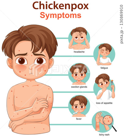 Chickenpox Symptoms in Children Illustrated Medical Infographic 130869910
