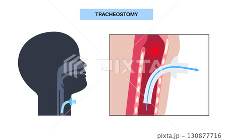 Tracheostomy medical poster Tracheostomy medical poster 130877716