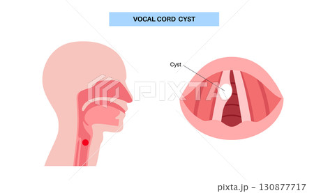 Vocal cord cyst Vocal cord cyst 130877717