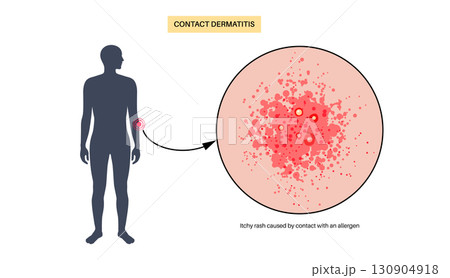 Contact dermatitis poster Contact dermatitis poster 130904918