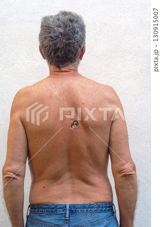 Electric shock exit wound showing on mature man's back 130915007