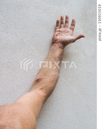 Electrical burn wounds showing entry and exit points on arm and hand 130915019