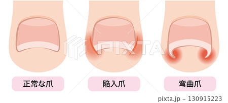 巻き爪・陥入爪・弯曲爪 130915223