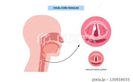 Vocal cord cyst Vocal cord cyst 130916033