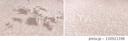 Skin surface before and after the melasma treatment procedure. 3D-rendered illustration showing reduce pigmentation and dark spots after laser therapy, microneedling, chemical peels, or topical creams Skin surface before and after the melasma treatment procedure. 3D-rendered illustration showing reduce pigmentation and dark spots after laser therapy, microneedling, chemical peels, or topical creams 130921396