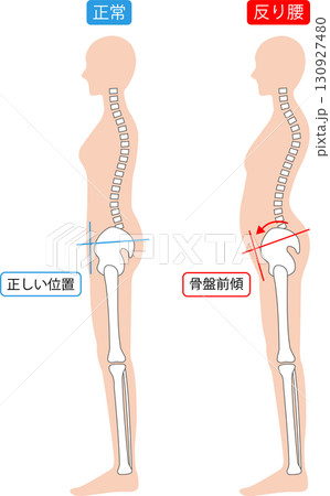 反り腰と正常な姿勢の女性　背骨と骨盤 130927480