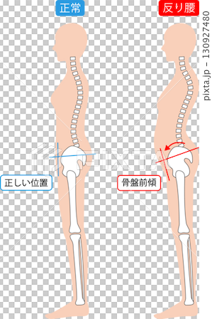 反り腰と正常な姿勢の女性　背骨と骨盤 130927480