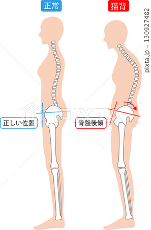 反り腰と猫背な姿勢の女性　背骨と骨盤 130927482