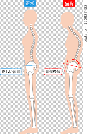反り腰と猫背な姿勢の女性　背骨と骨盤 130927482