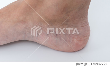 Varicose veins visible on a woman's leg, showcasing skin texture and condition, emphasizing health concerns and aesthetic issues related to circulation 130937779