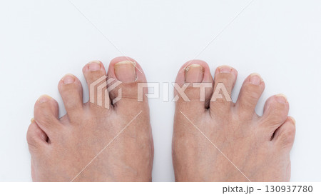 Close-up view of feet with nail psoriasis showing affected toenails and skin texture, highlighting the condition and its impact on foot health Close-up view of feet with nail psoriasis showing affected toenails and skin texture, highlighting the condition and its impact on foot health 130937780