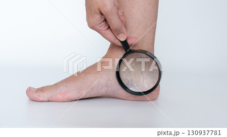 Close-up view of a hand holding a magnifying glass over a foot with visible varicose veins, highlighting the condition of swollen legs and veins 130937781