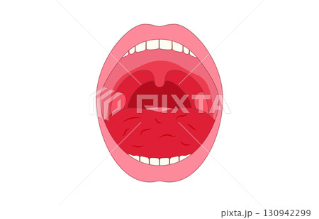 Xerostomia or dry mouth Xerostomia or dry mouth 130942299