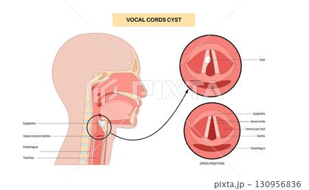 Vocal cord cyst Vocal cord cyst 130956836