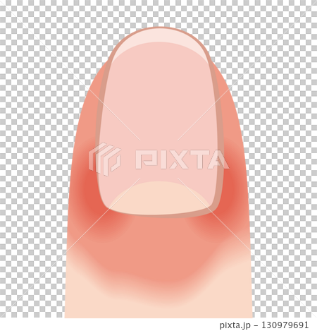 Candidal paronychia nails 130979691