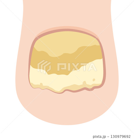 爪白癬・爪水虫 爪白癬・爪水虫 130979692