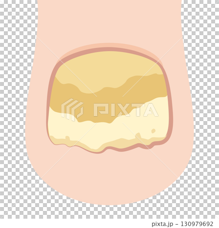 Onychomycosis and onychomycosis 130979692