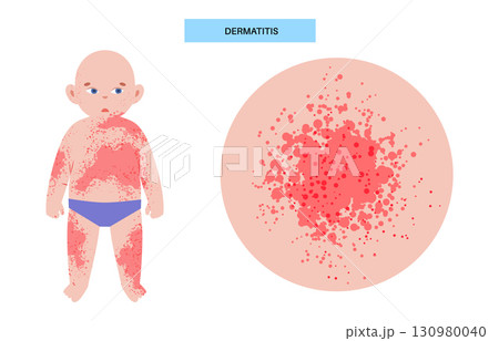 Dermatitis medical poster 130980040